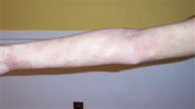eczema arm before